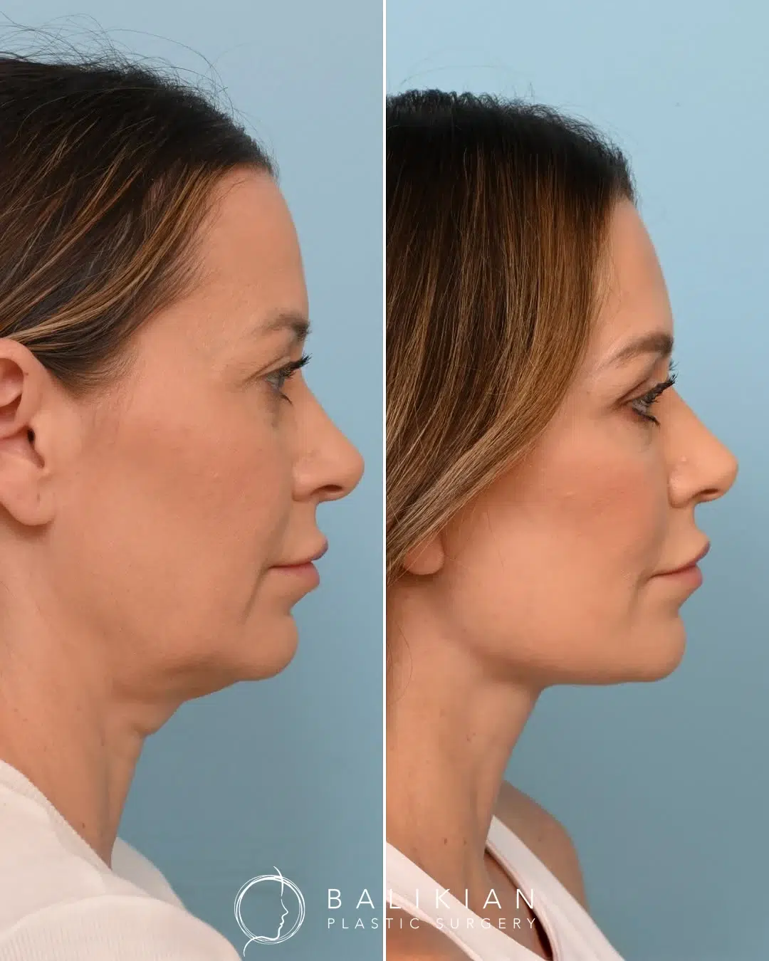 Profile view before and after Artiste Lift facelift highlighting sculpted neck and jawline definition.