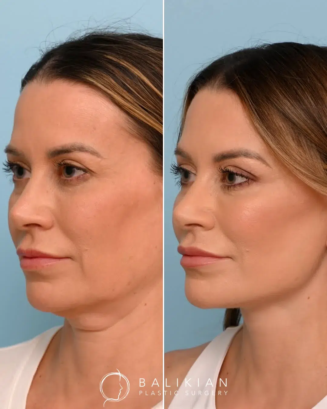 Three-quarter opposite view before and after facelift showing defined jawline and improved lower face.