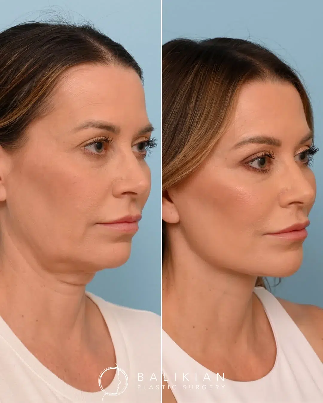 Three-quarter view before and after Artiste Lift facelift showing natural lift and smoother facial contours.