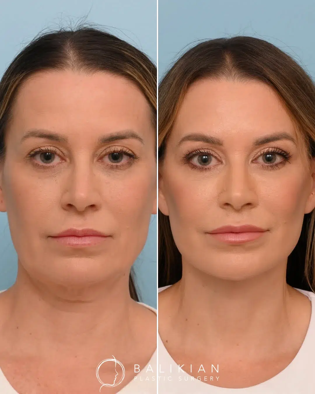 Front view before and after Artiste Lift facelift by Dr. Richard Balikian showing tighter jawline and refreshed face.
