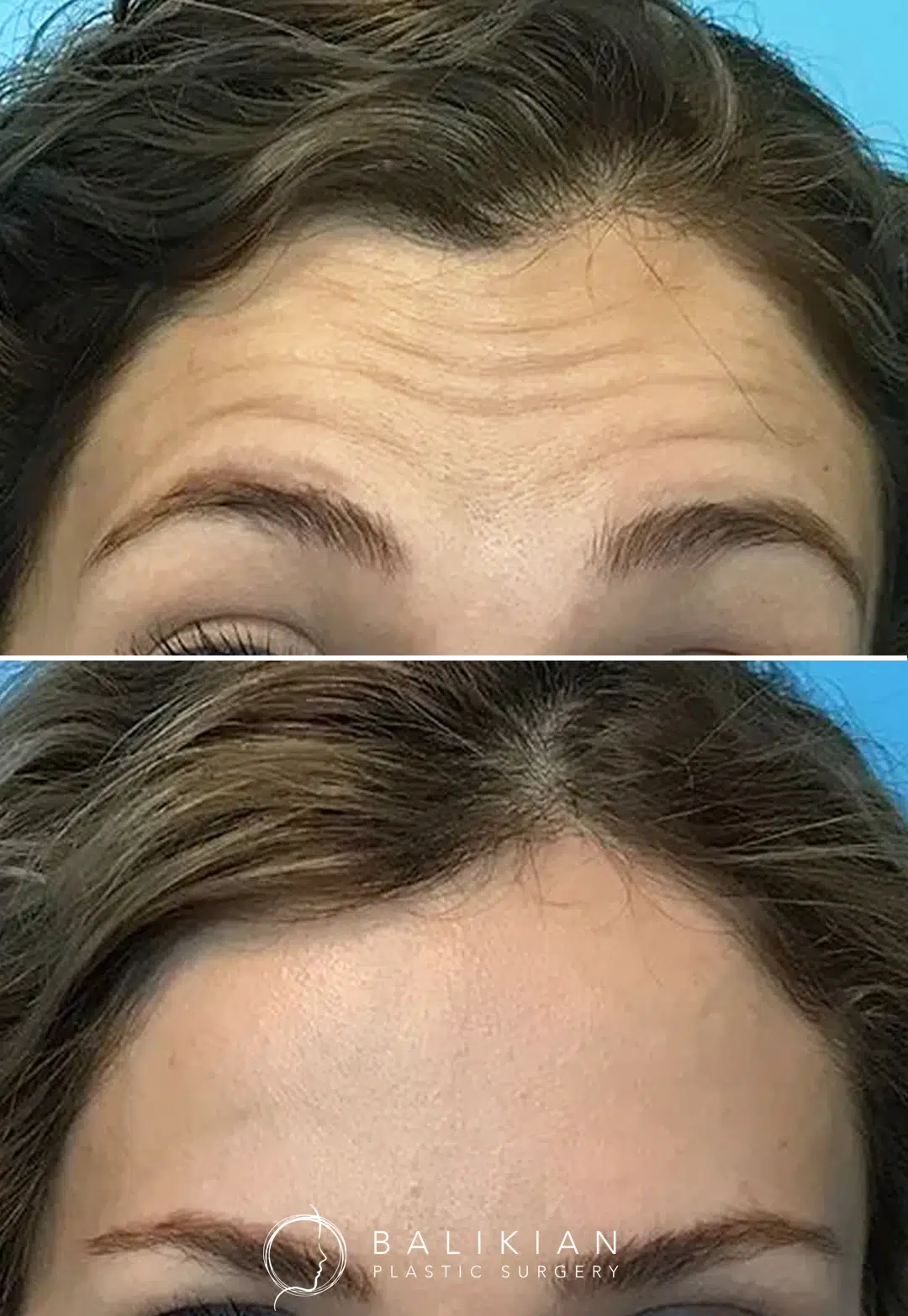 Before and after Botox treatment showing a woman's forehead with deep horizontal wrinkles that are dramatically smoothed post-treatment