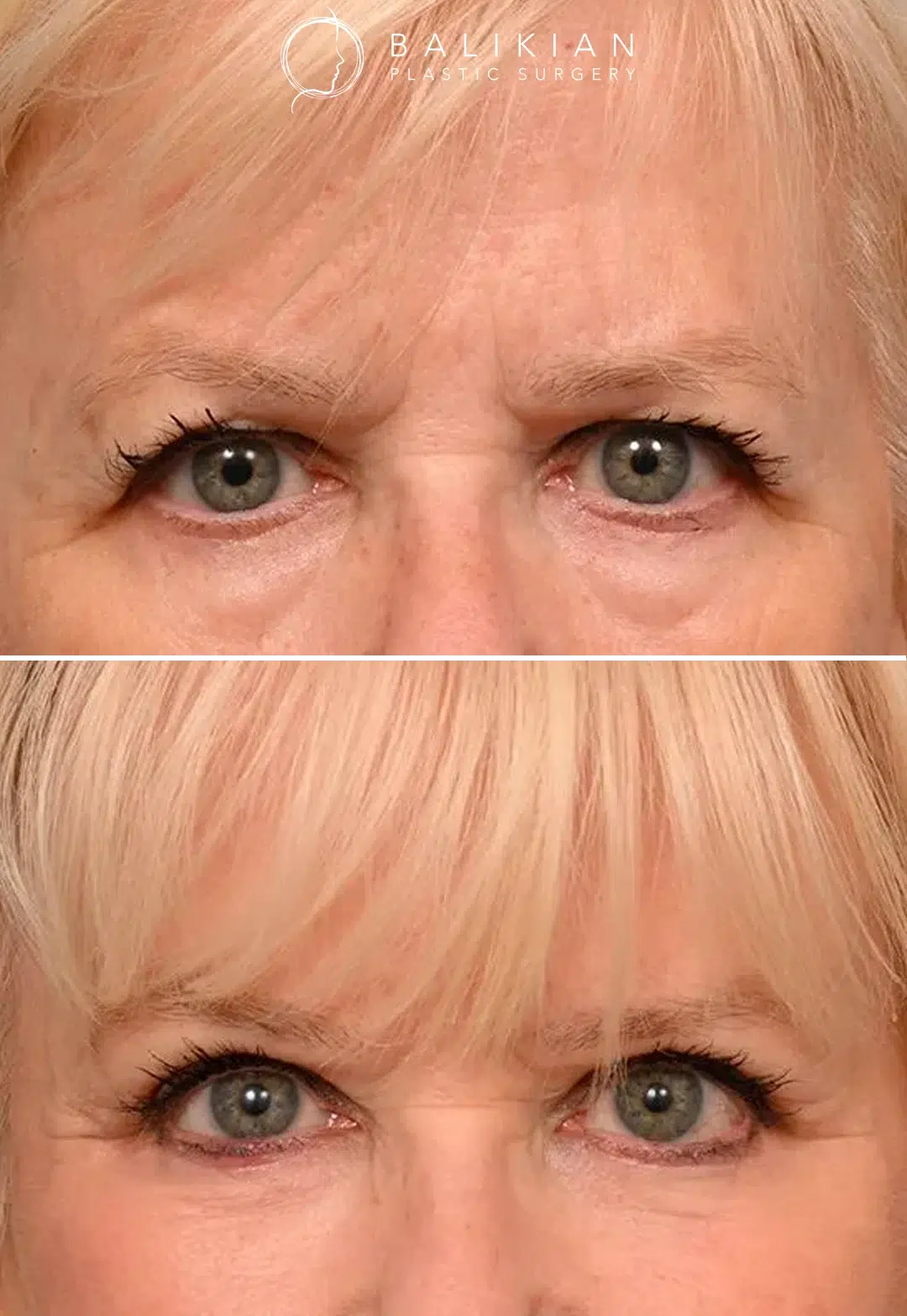 Before and after frontal view of a woman after brow lift procedure, highlighting lifted brow position, reduced frown lines, and refreshed eyes.