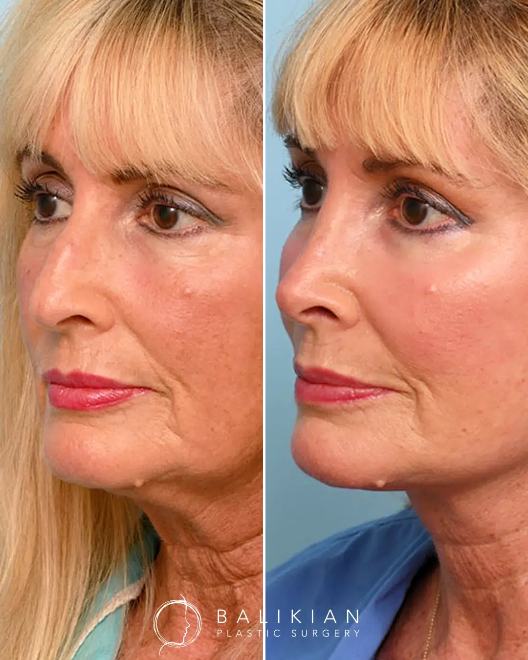 CO₂ laser skin resurfacing before and after with improved tone, reduced fine lines, and smoother facial skin.