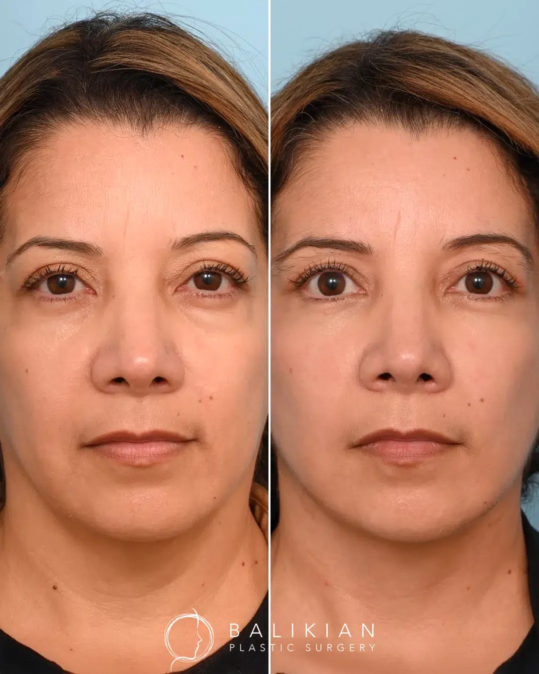 Facelift and neck lift before and after front view of a woman with smoother skin, refined jawline, and a natural refreshed appearance.
