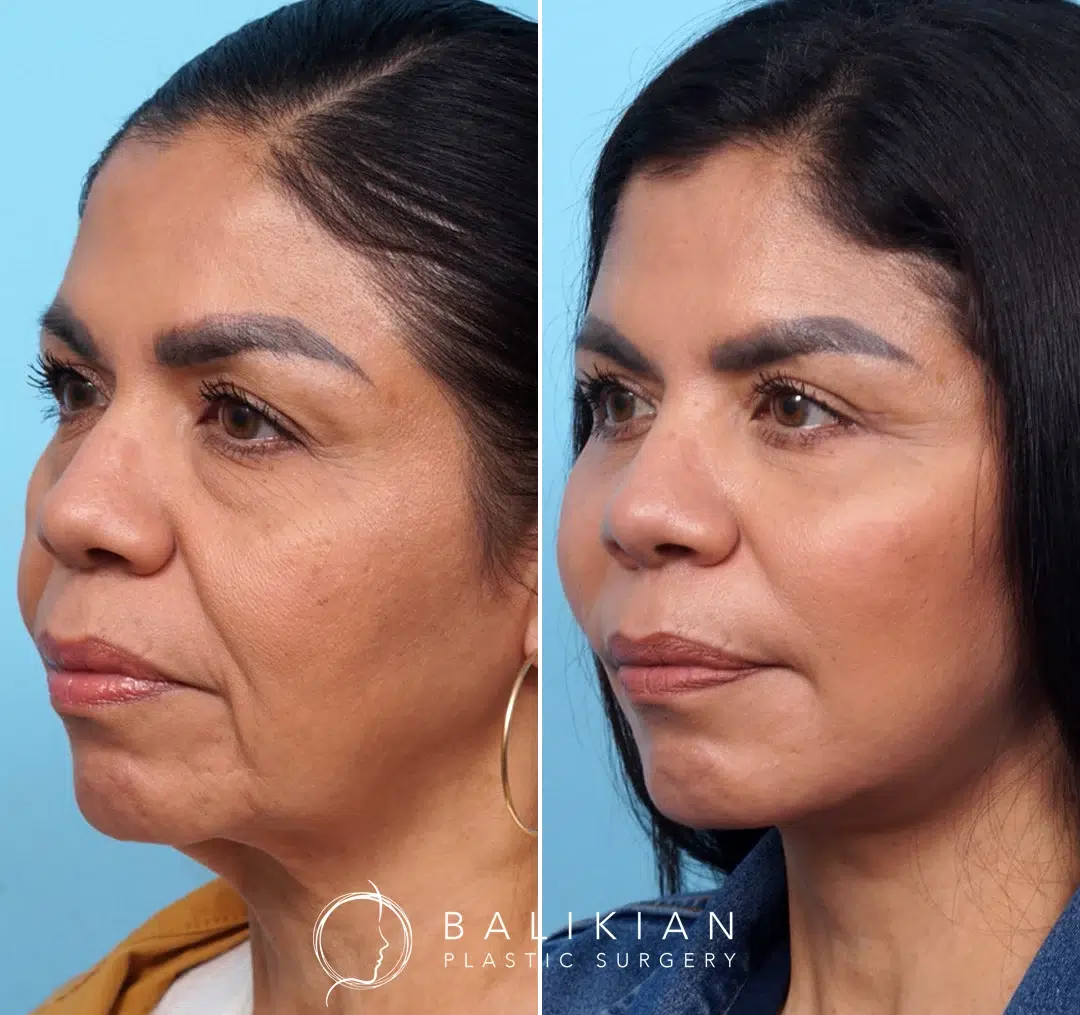 Angled view before and after facelift and neck lift, showing smoother skin and youthful facial balance.