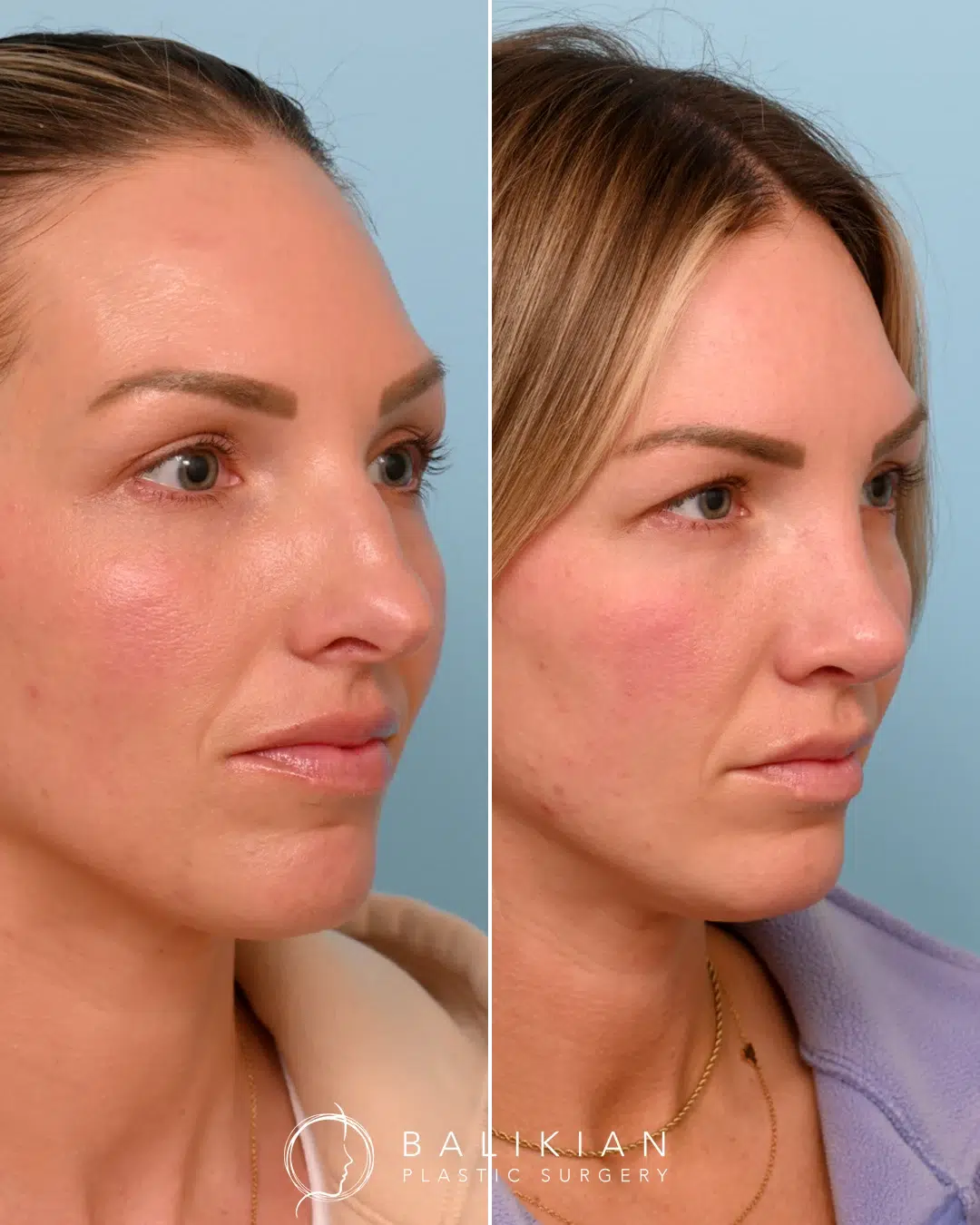 Side profile of same patient after rhinoplasty with smoother nasal bridge and improved contour.