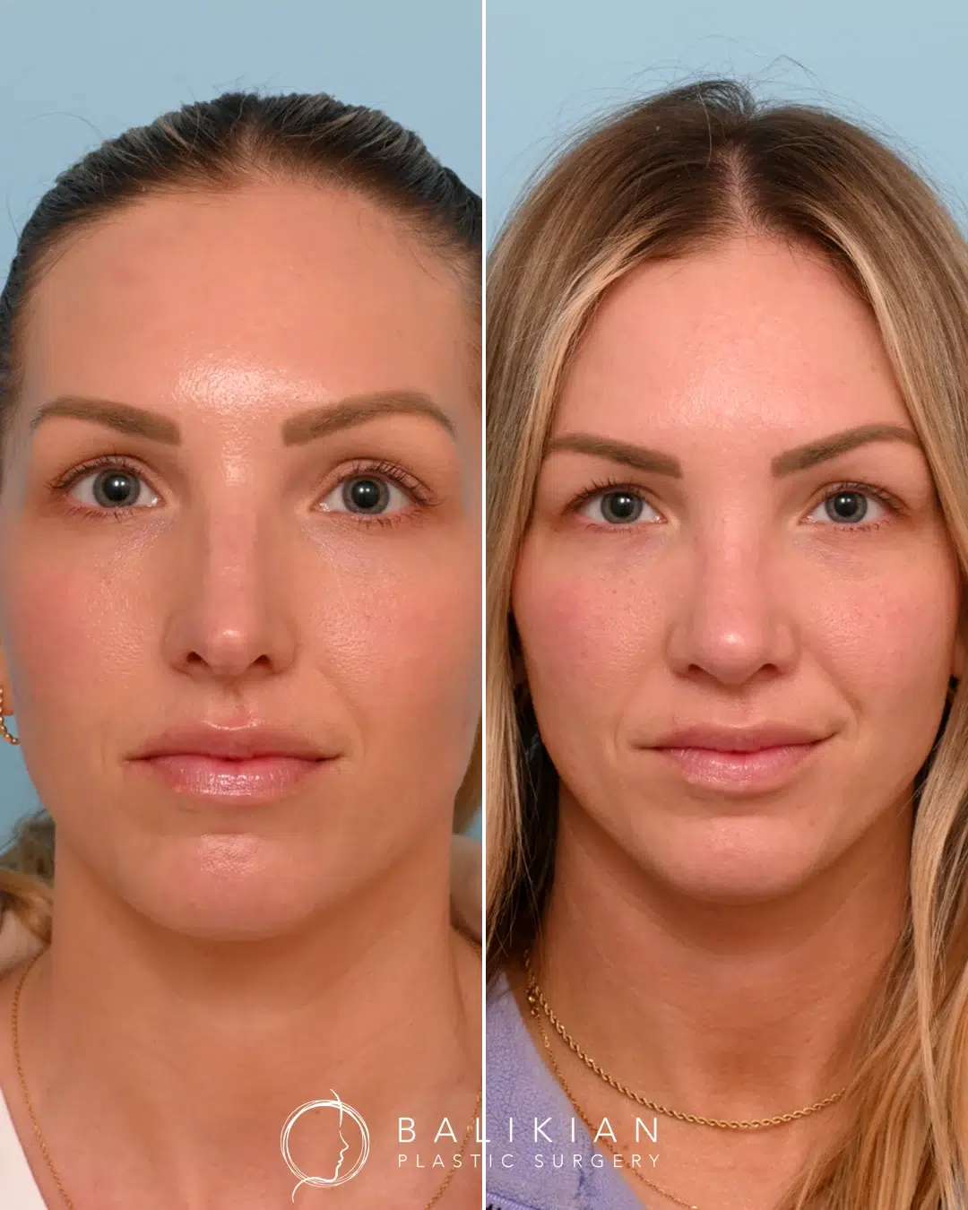 Front view before and after rhinoplasty, showing refined nasal shape and enhanced symmetry.