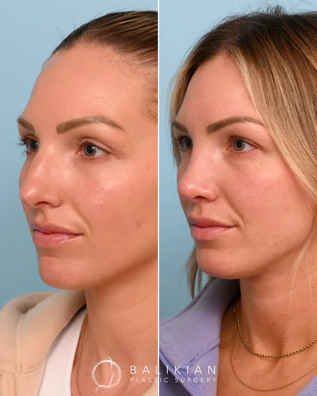 Side profile of female patient before rhinoplasty showing nasal hump and breathing concerns.