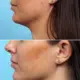Side-by-side comparison of a woman’s lower face and neck before and after Kybella treatment for a double chin.