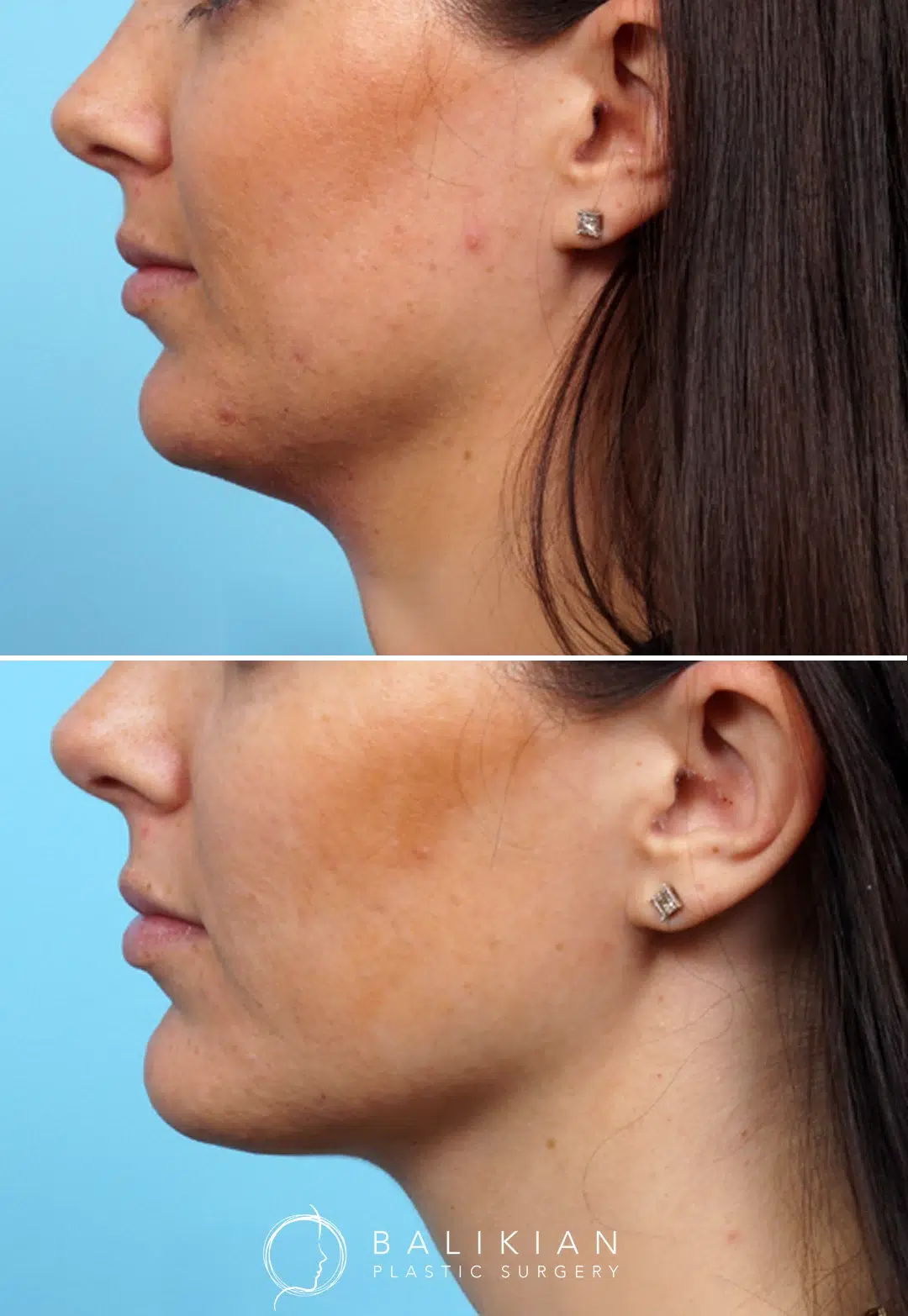 Side-by-side comparison of a woman’s lower face and neck before and after Kybella treatment for a double chin.