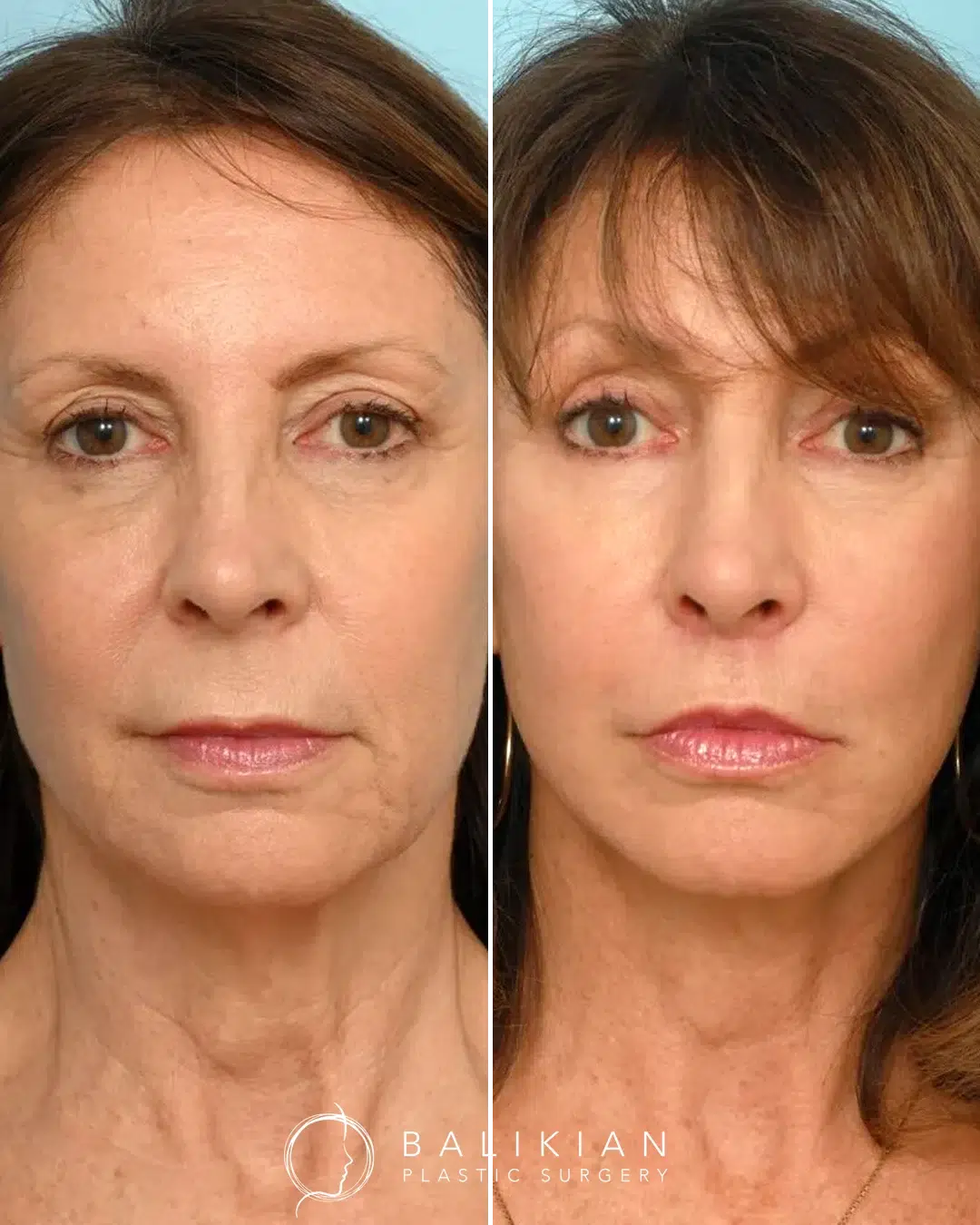 Fractionated CO₂ laser before and after at Balikian Plastic Surgery showing tighter skin and refreshed overall appearance.