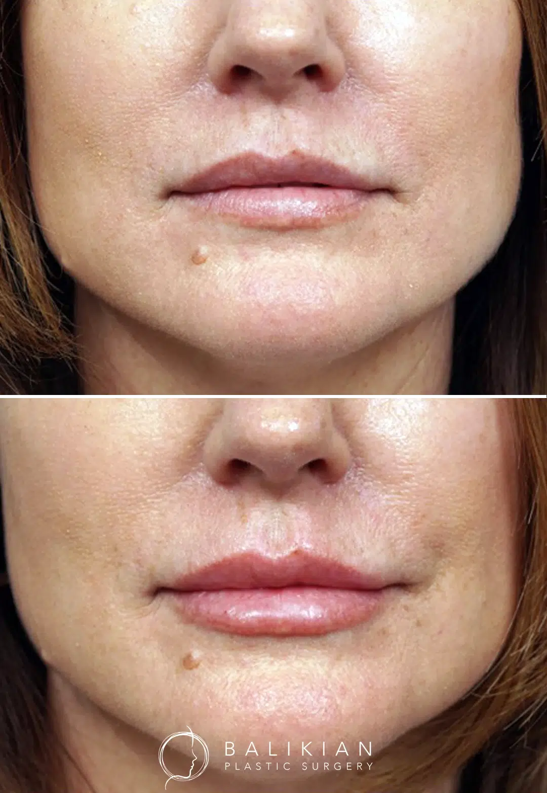 Before and after image of a woman’s lips, demonstrating increased volume and a smoother lip contour after augmentation