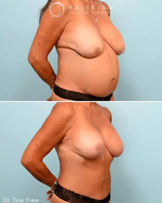 Side view of a female patient before and after Mommy Makeover, highlighting lifted breasts and a tightened abdominal area.