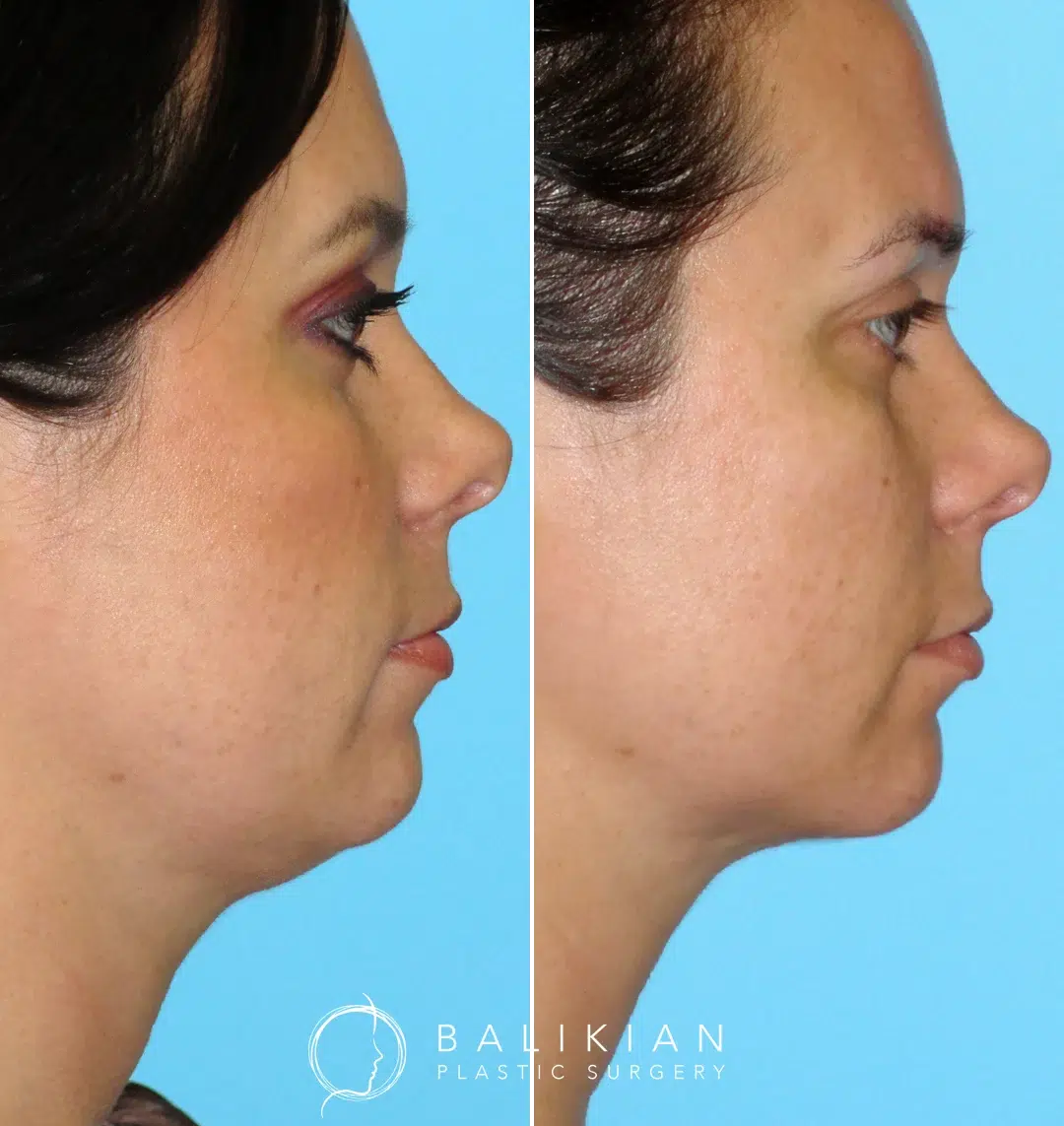 Highlighting the removal of excess fat beneath the chin, improving jawline contour.