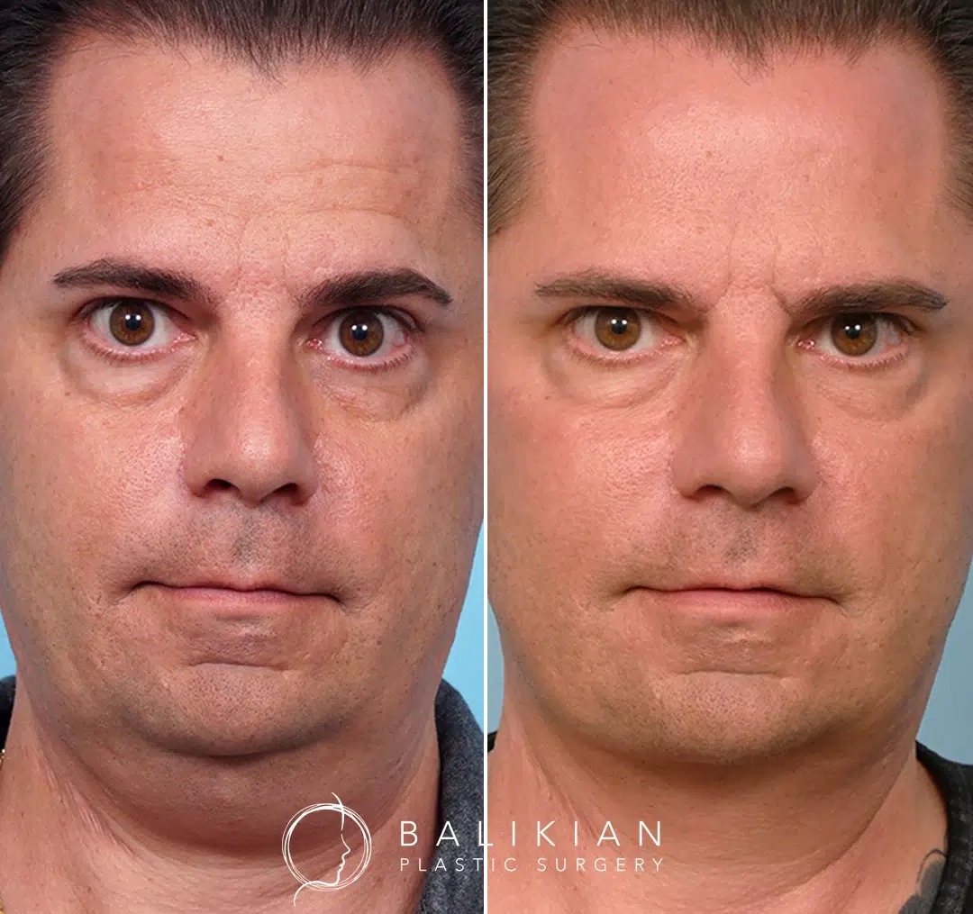Front-facing before-and-after photos of a middle-aged man following facelift surgery, showing reduced sagging under the chin, tighter skin, and a more defined jawline.