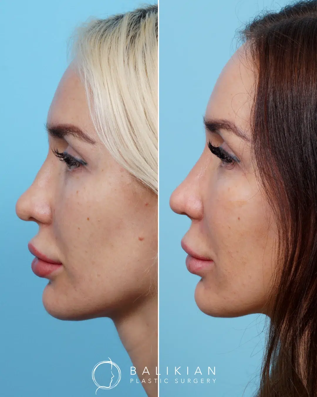 Left profile before and after revision rhinoplasty on a woman, showing a straighter nasal bridge and reshaped tip.