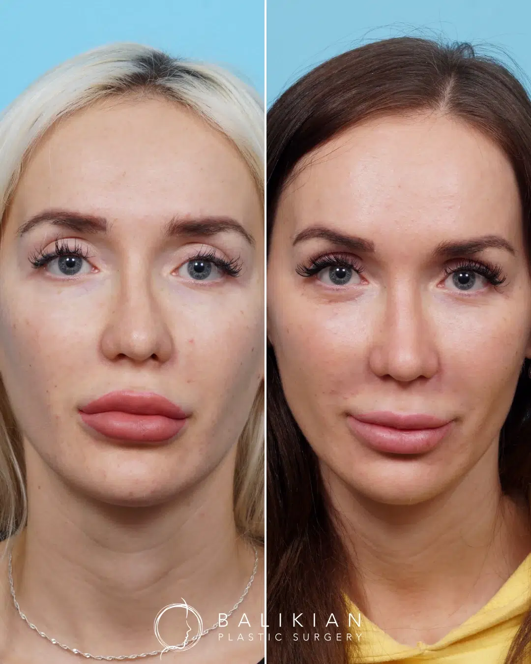 Frontal view before and after revision rhinoplasty on a woman, showing a narrower bridge and improved nasal symmetry.