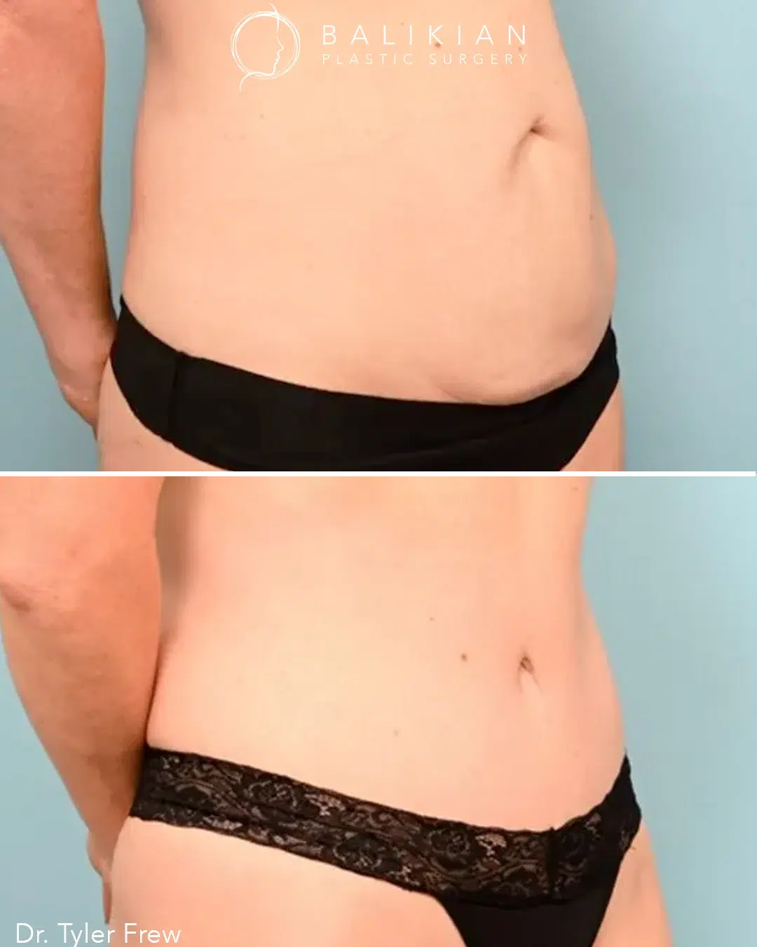 Side view before and after tummy tuck surgery showing removal of excess lower abdominal skin and improved flat, smooth profile.