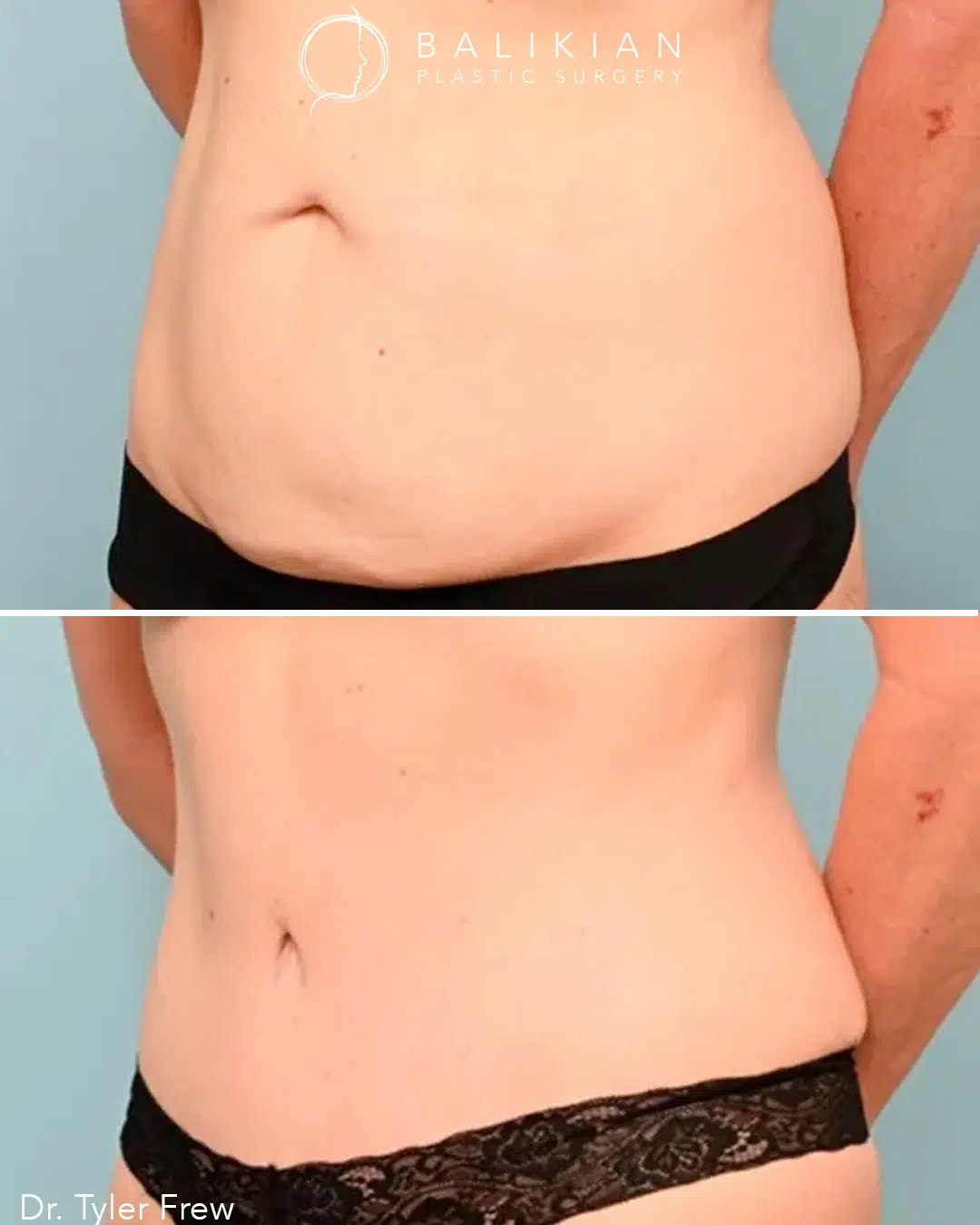 Back oblique view before and after abdominoplasty highlighting reduced loose skin and a slimmer, more contoured waist.