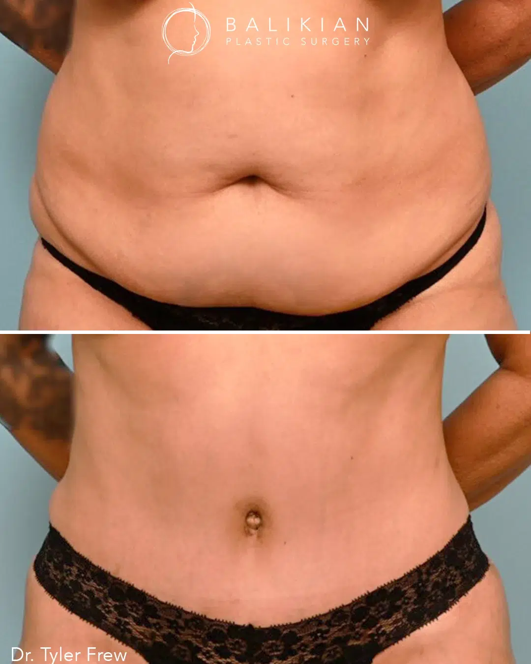 Front view before and after abdominoplasty highlighting transformation from a protruding abdomen to a flat, sculpted midsection.