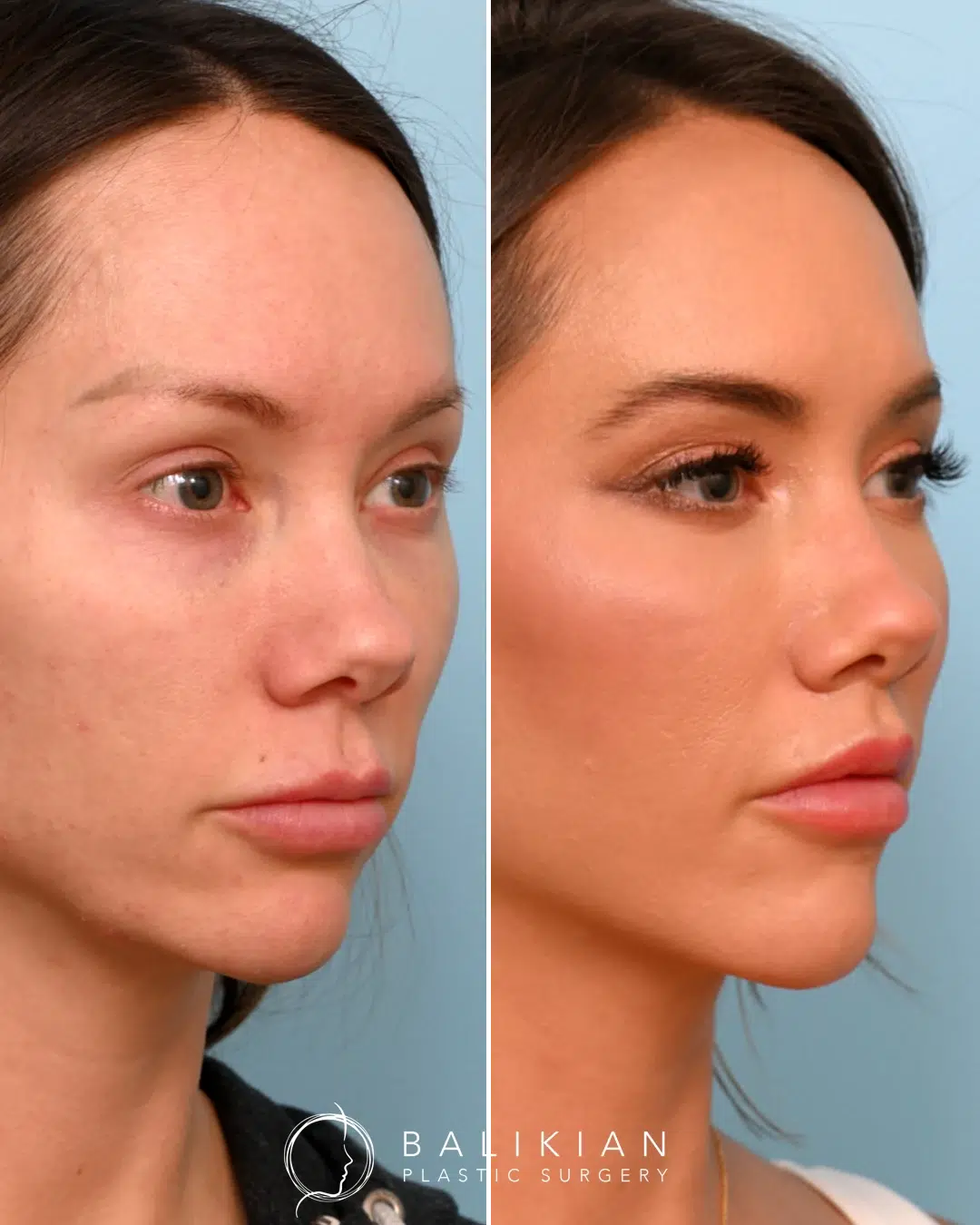 Lip lift before and after angled view featuring a refined cupid’s bow, enhanced lip fullness, and improved facial harmony.