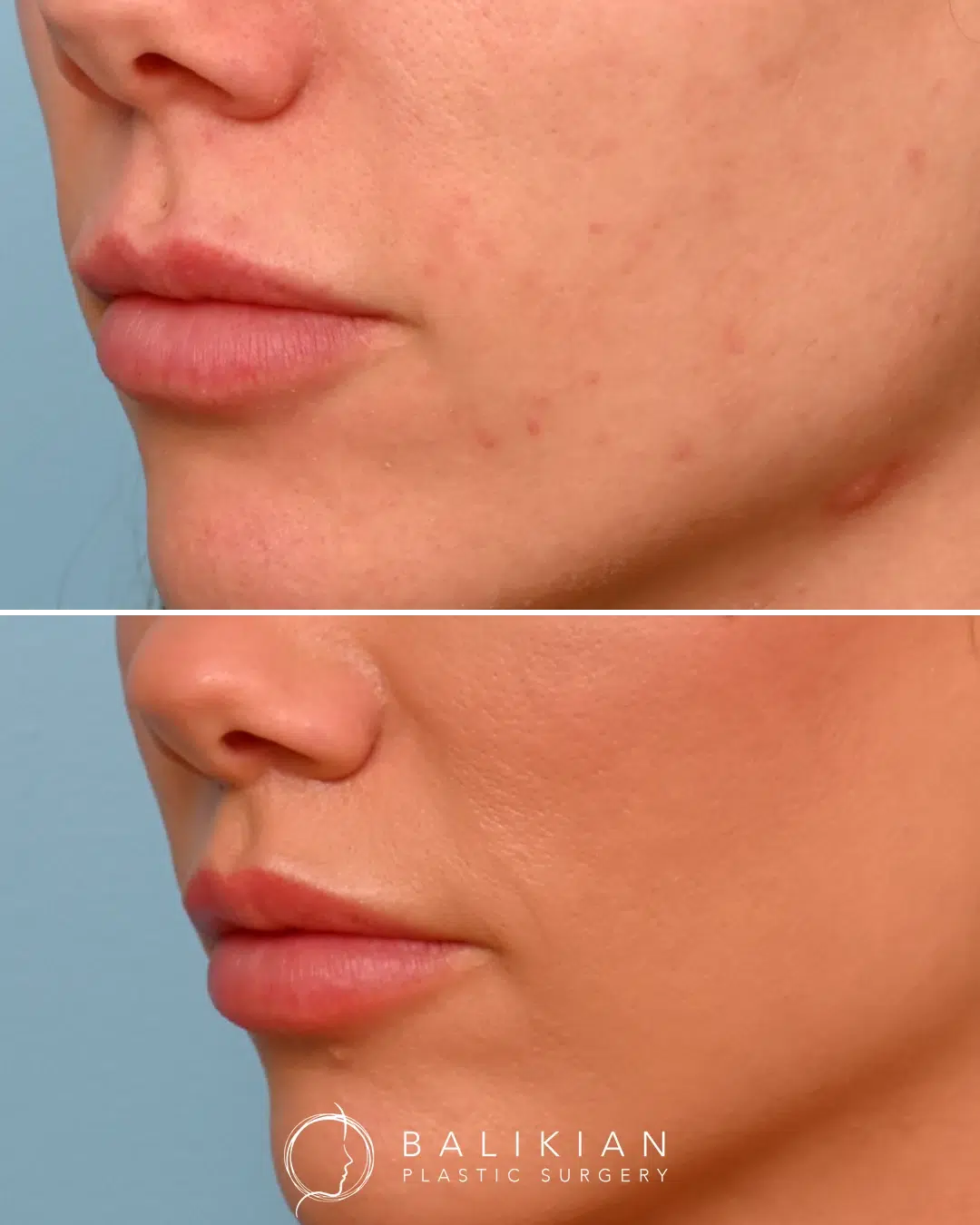 Lip lift before and after close-up highlighting natural upper lip lift results with improved shape and definition.