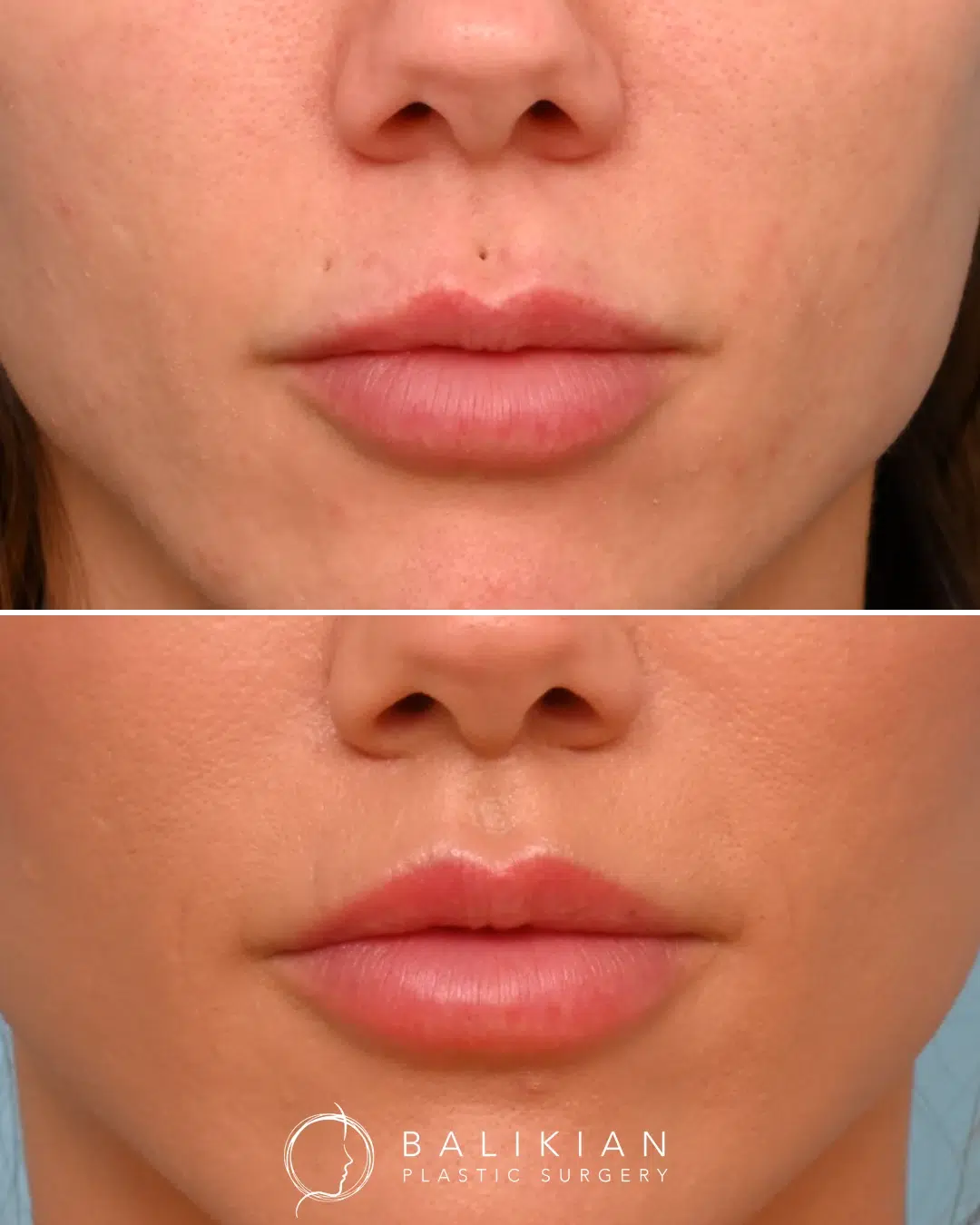 Upper lip lift before and after front view showing balanced proportions, fuller lip appearance, and natural smile enhancement.
