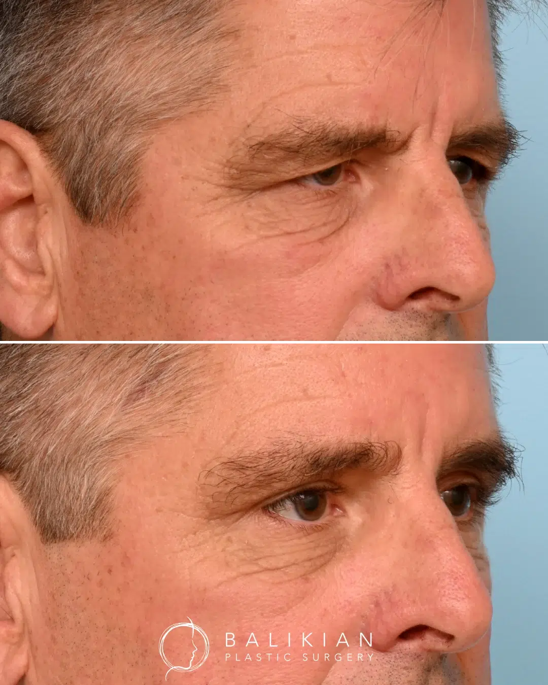 Before and after male blepharoplasty, reducing heavy upper lids and revealing a more open, refreshed gaze.