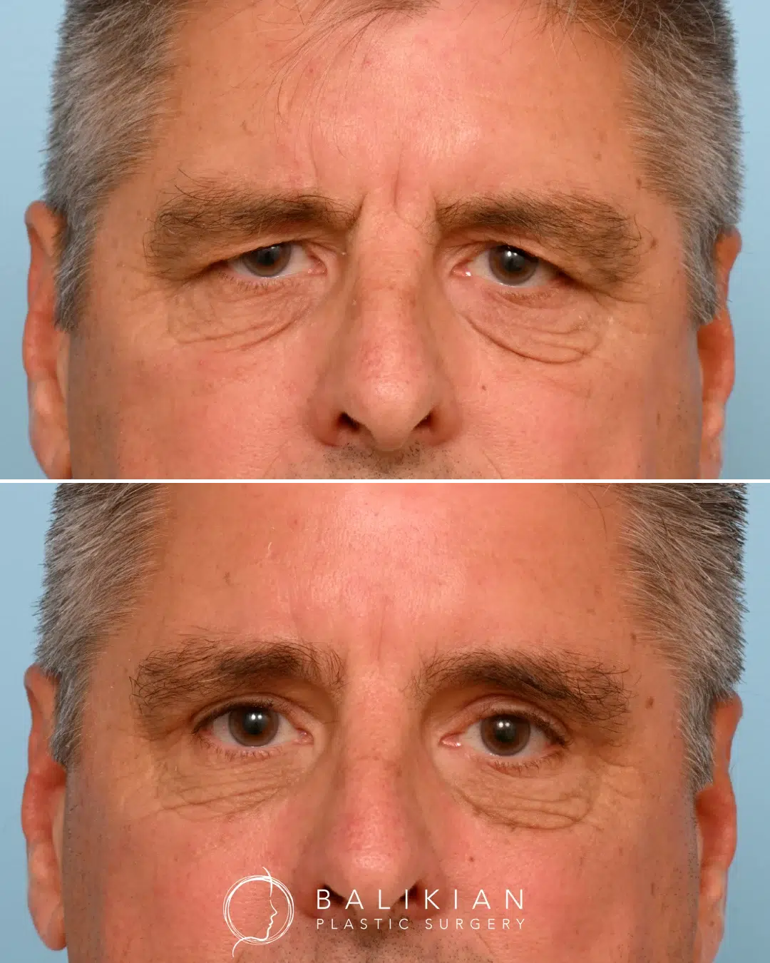 Side-by-side male eyelid surgery results, showing lifted upper lids and a naturally youthful eye area.