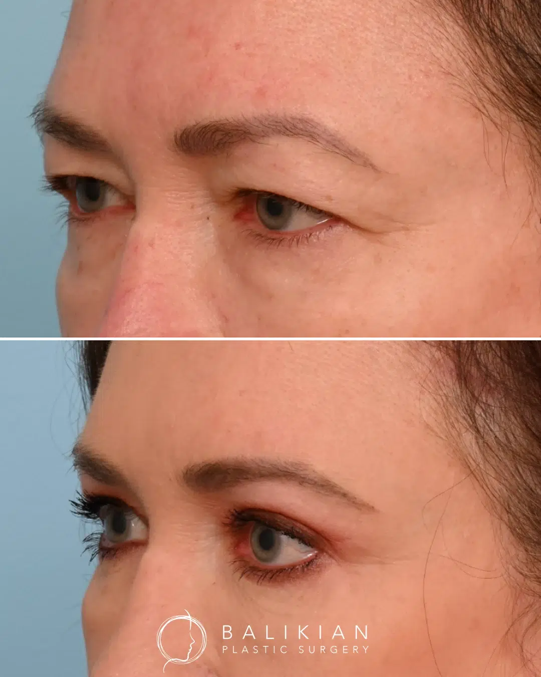 Before and after upper eyelid blepharoplasty, improving symmetry and reducing excess eyelid skin.