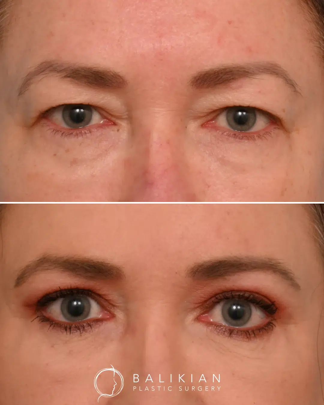 Close-up before and after of upper eyelid surgery, revealing lifted contours and a more vibrant, open-eyed appearance.