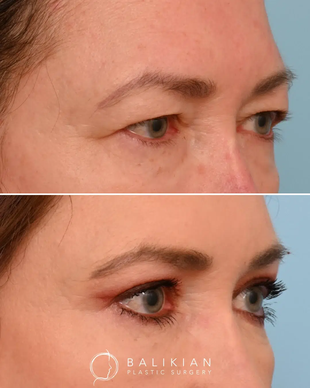 Close-up before and after of upper eyelid surgery, showing smoother contours and brighter eyes.