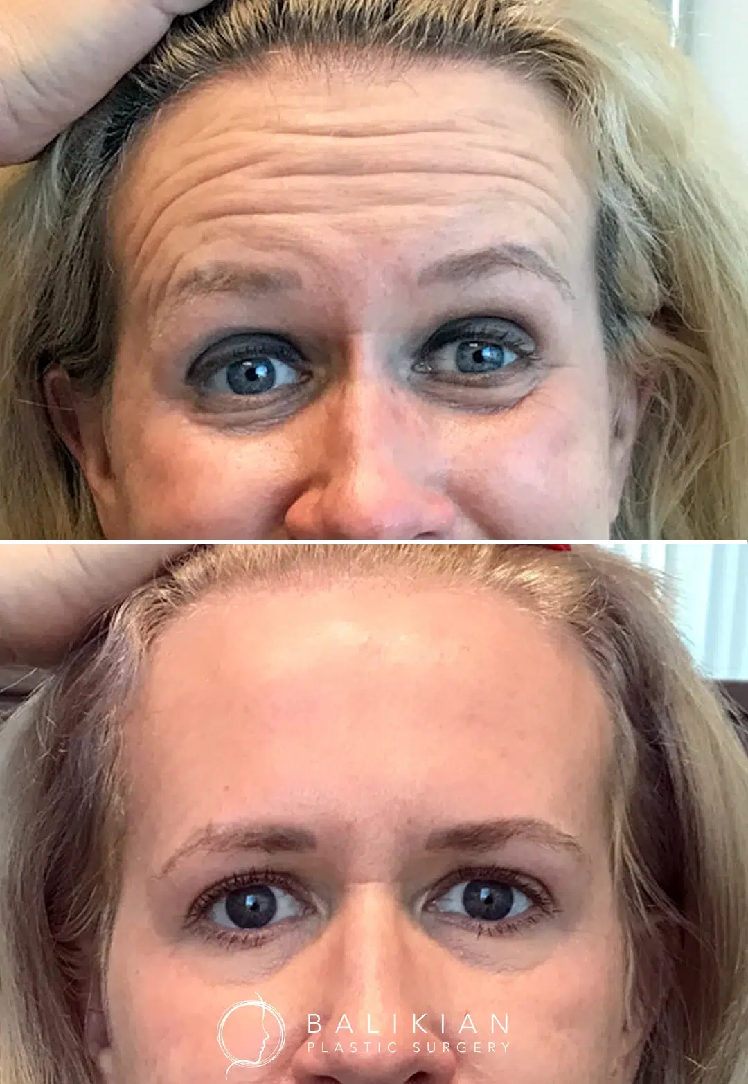 Before and after Botox photo of a woman with raised eyebrows and visible forehead lines, followed by a smooth, relaxed forehead and refreshed appearance