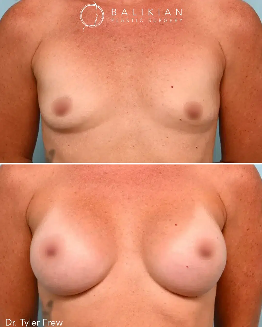 Before and after angled side view showing the effects of breast augmentation. The after image displays fuller, rounder breasts with more forward projection than the smaller, natural breasts in the before image.