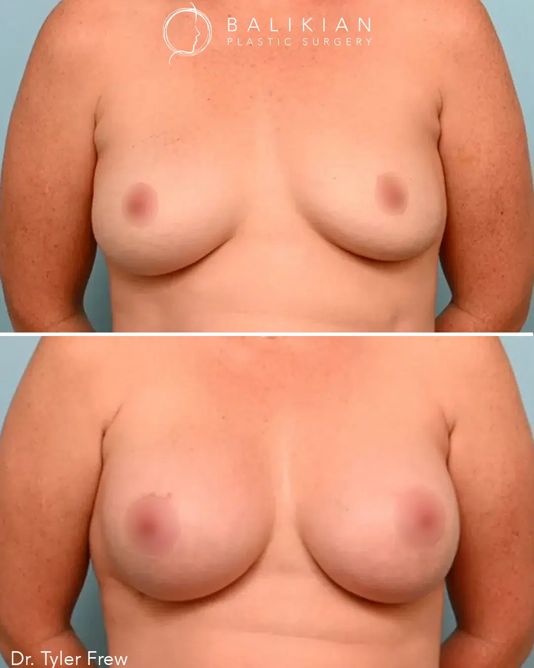 Front view before-and-after of a breast lift with implants, showing enhanced fullness, lifted shape, and improved symmetry.