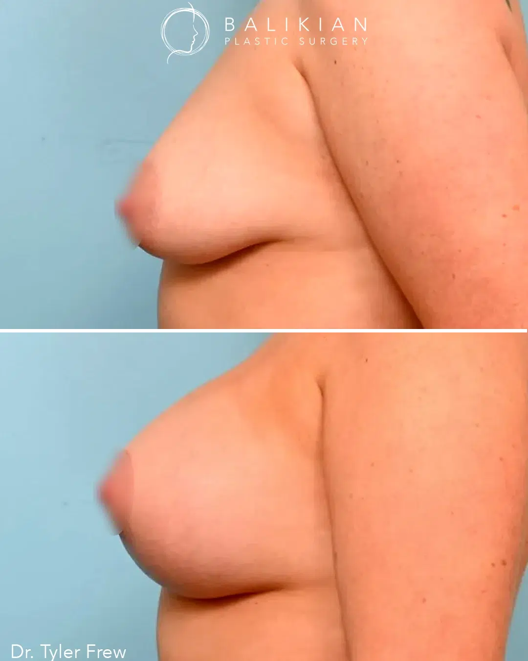 Before image shows moderate breast ptosis. After image shows perkier breasts with rounder shape and enhanced upper pole fullness.