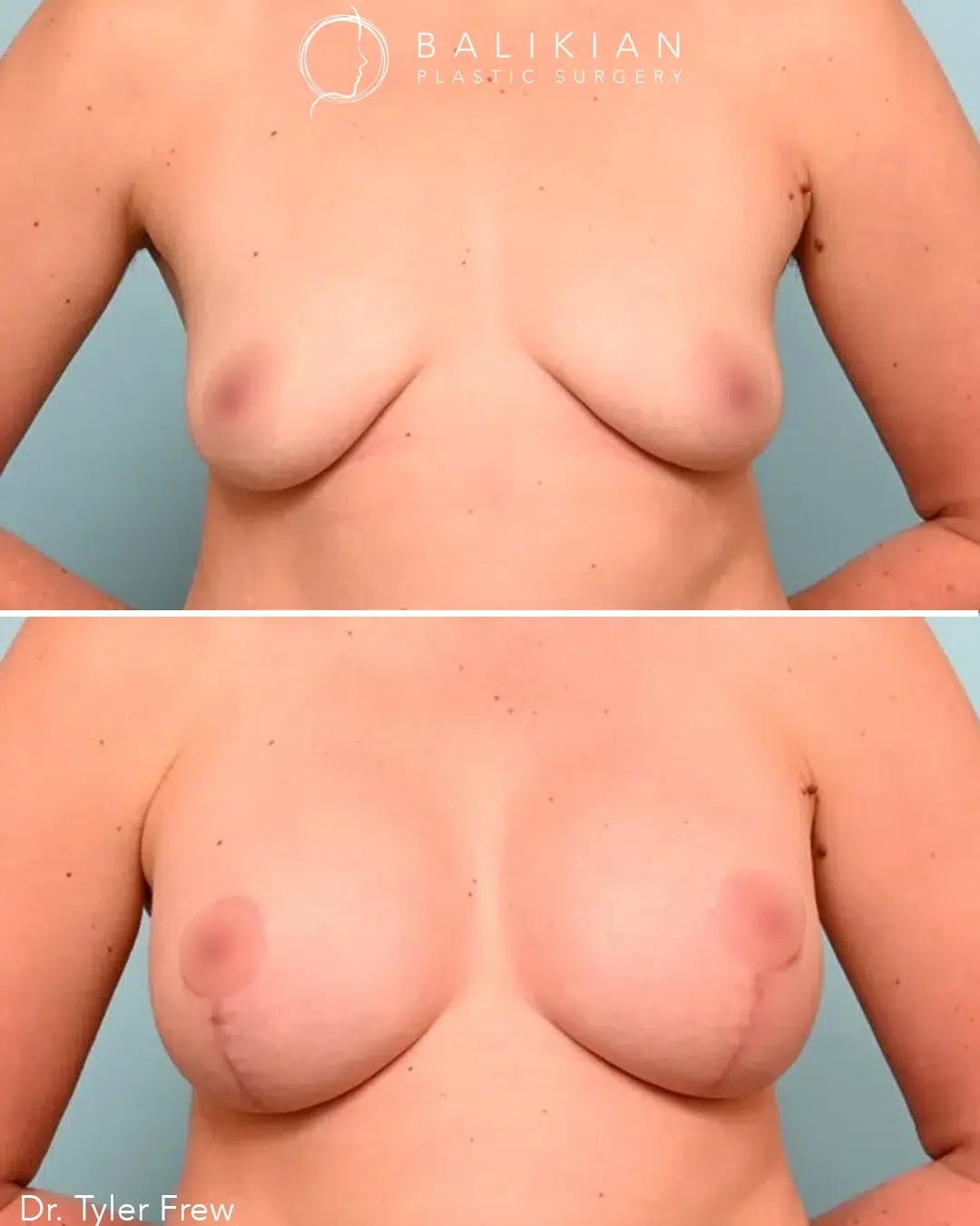 Before image shows breasts with visible sag and nipples positioned low on the breast mound. After image shows higher, firmer breasts with more youthful proportions.