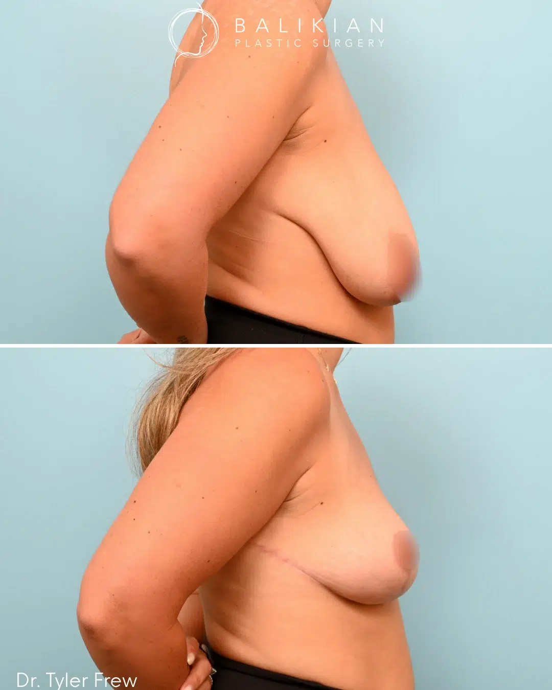 Side view of patient before and after breast reduction, showing reduced breast volume and a more youthful shape.