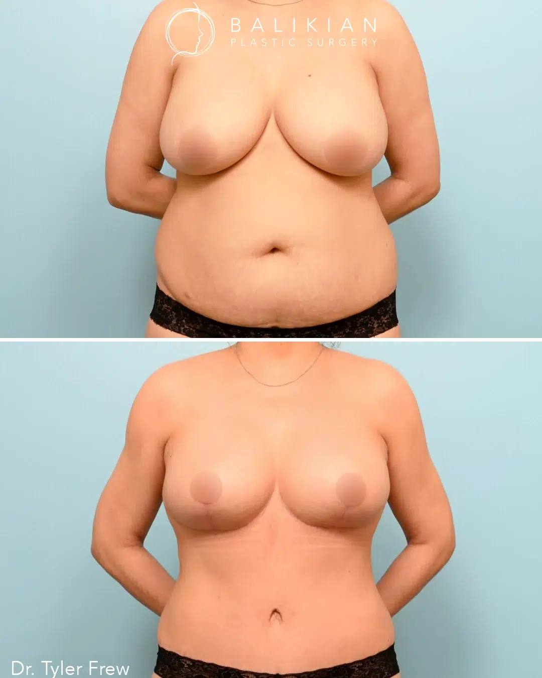 Side view before and after combined breast reduction and tummy tuck, showing smaller lifted breasts and a smoother abdominal contour.