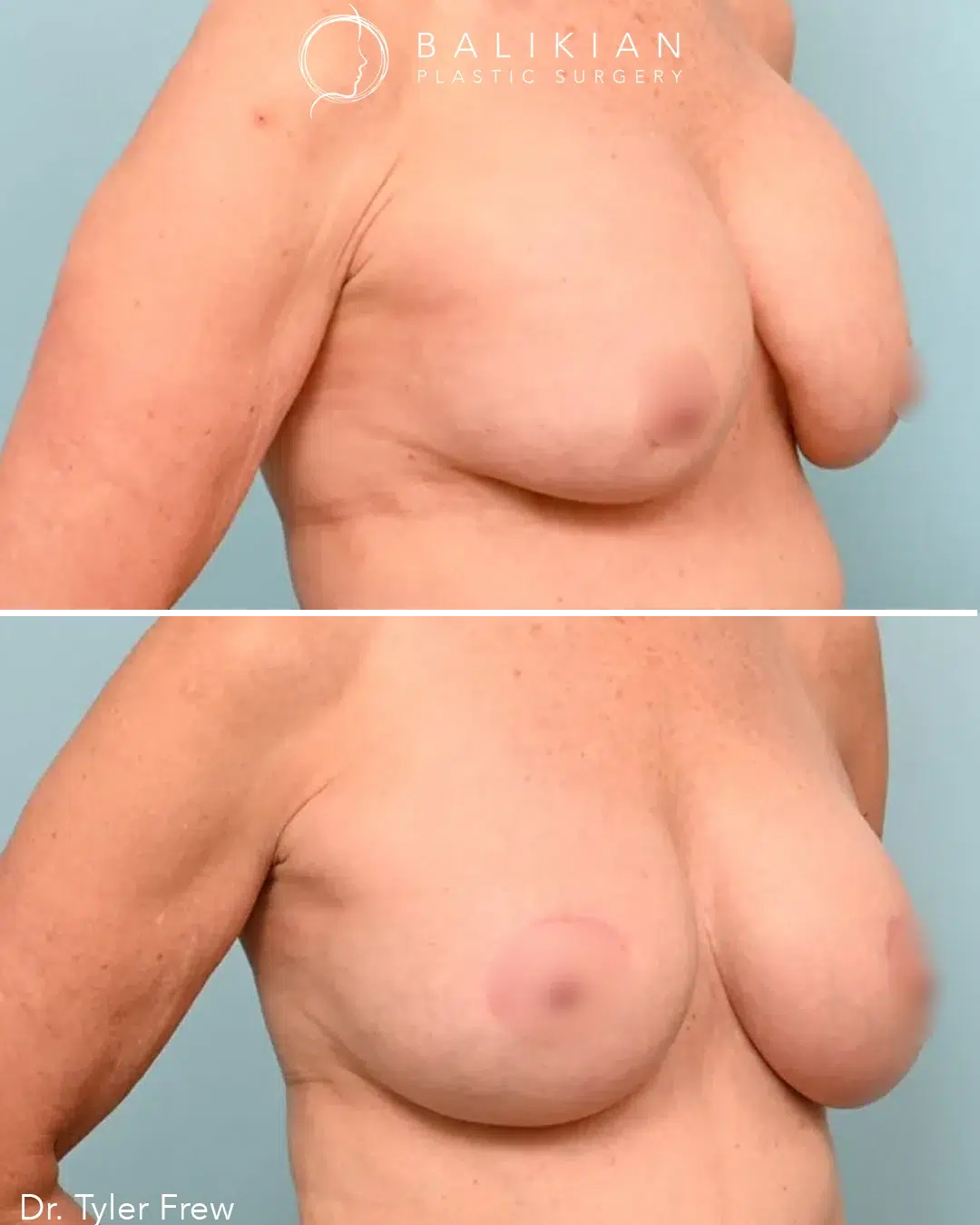 Side view before and after photo of a patient who had breast revision surgery with Dr. Tyler Frew, addressing capsular contracture for a softer, more natural appearance.