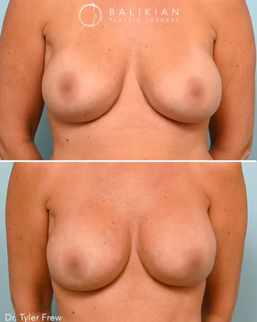 Before and after photo of a patient’s breast revision with Dr. Tyler Frew, showing correction of asymmetry and improved breast shape.