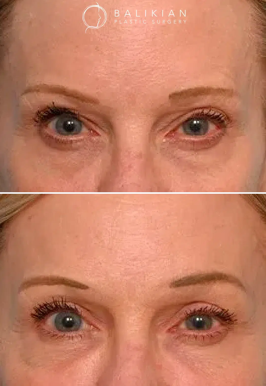 Before and after frontal view of a woman following brow lift surgery, with higher brows, smoother forehead, and brighter, more open eyes.