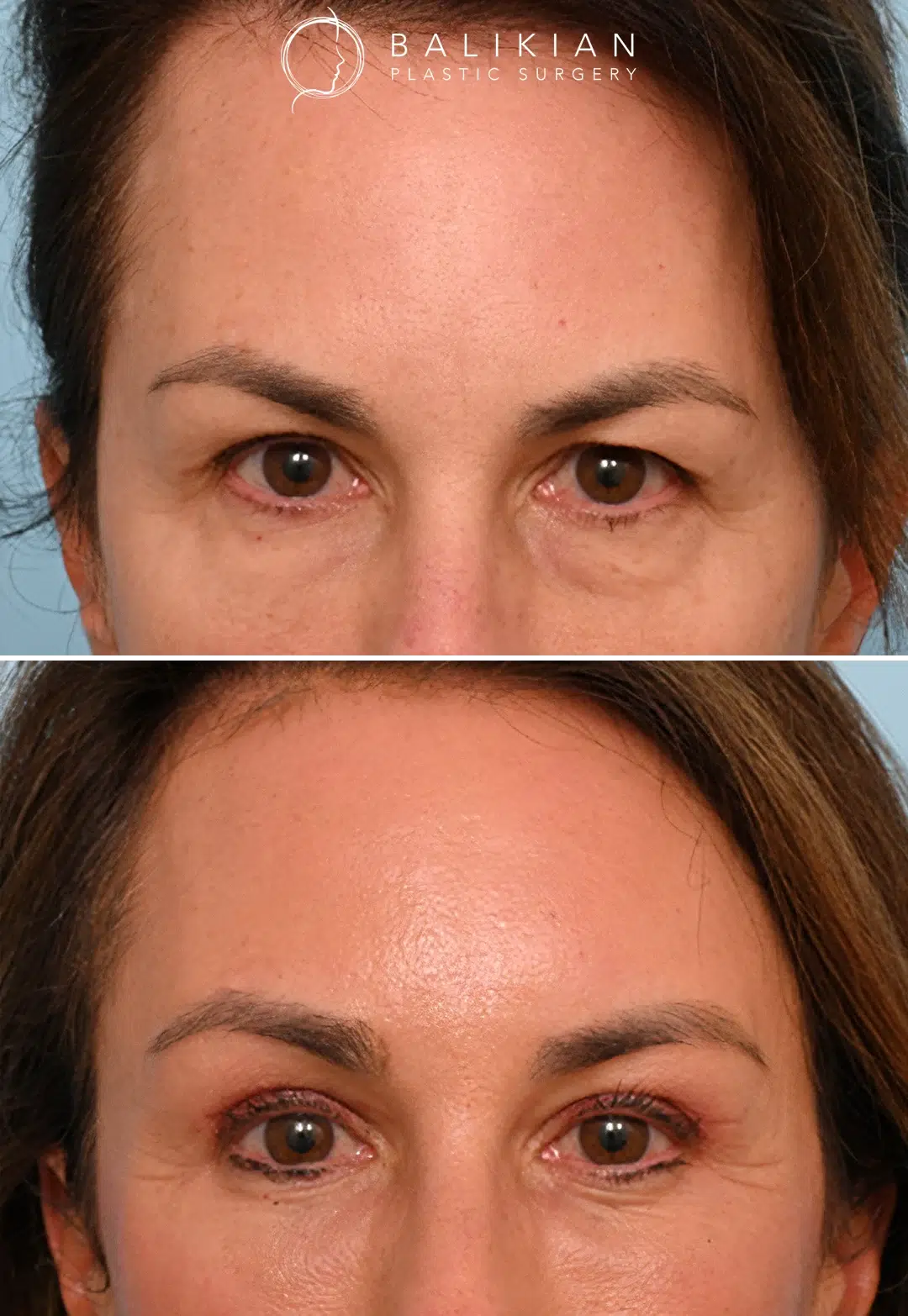 Before and after oblique view of a woman following brow lift surgery, showing elevated brow position, smoother forehead, and refreshed upper eye area.