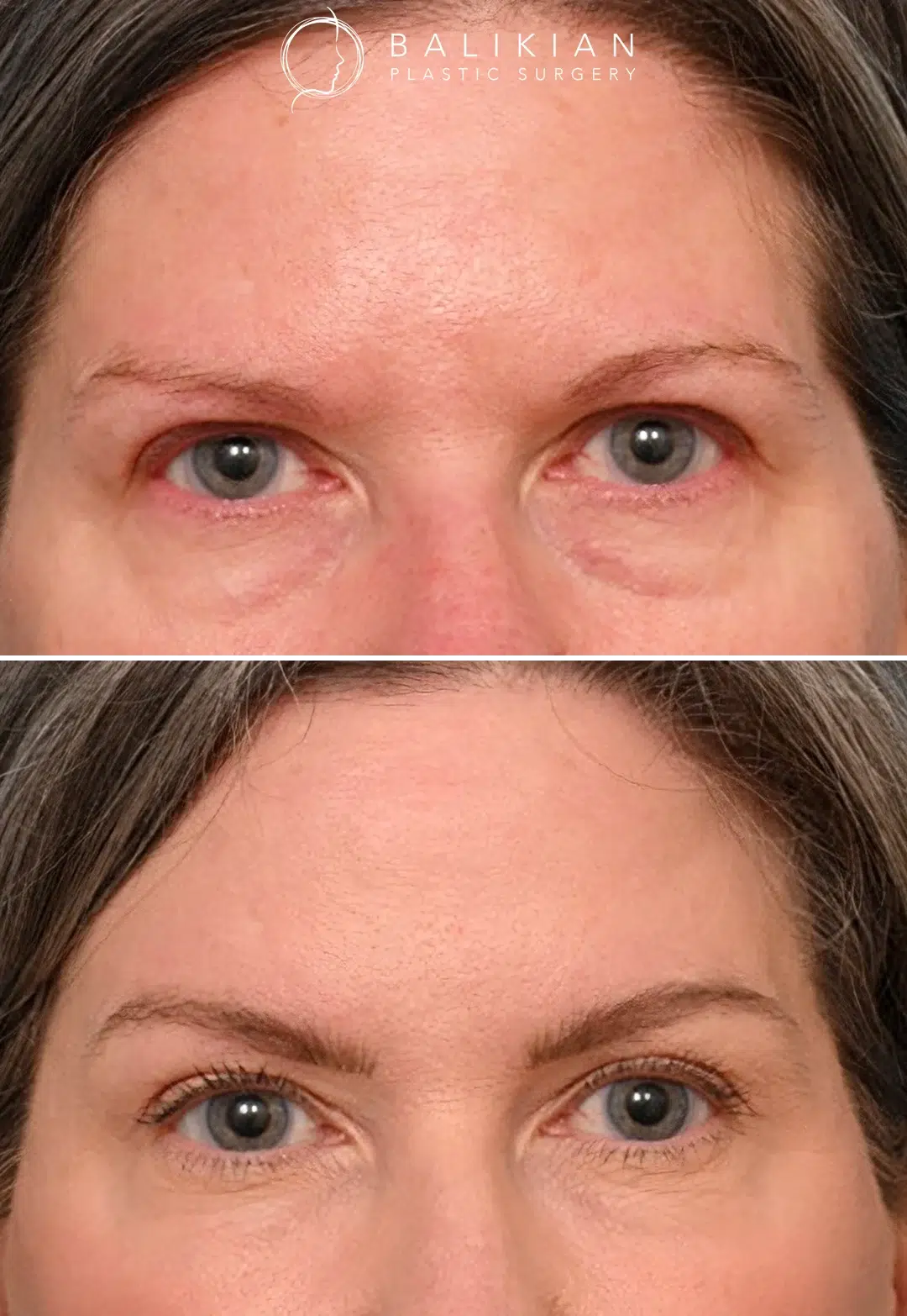 Before and after oblique view of a woman after brow lift surgery, with a higher brow arch and smoother skin near the temples.