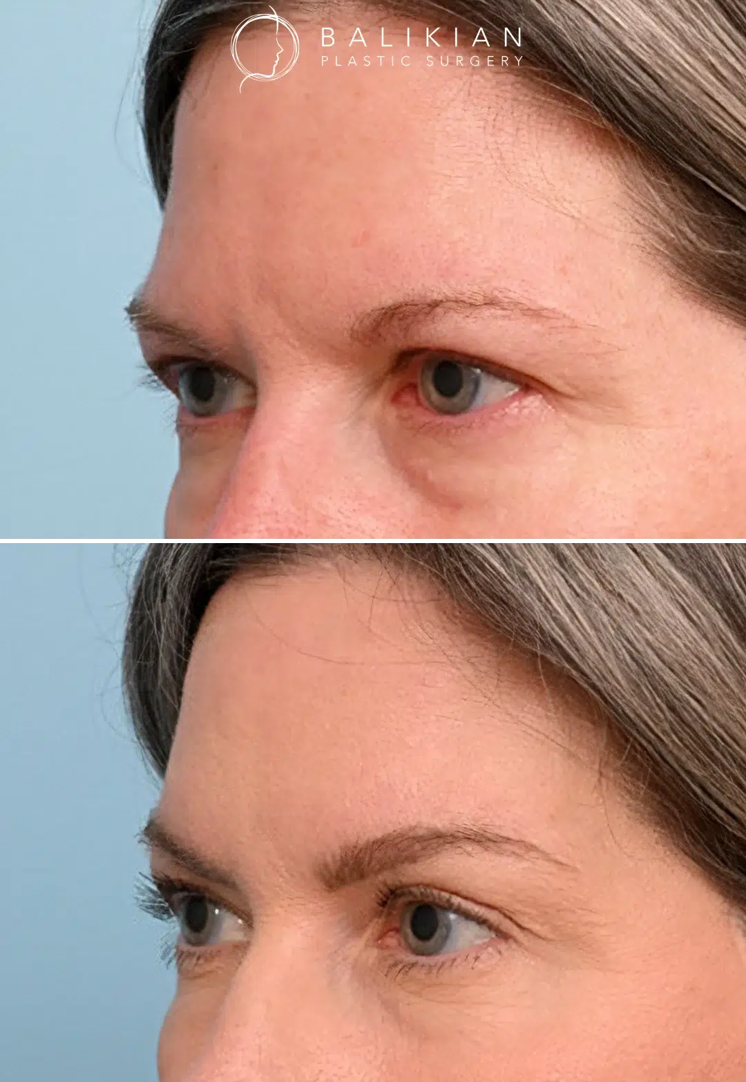 Before and after frontal view of a woman following brow lift surgery, showing improved brow symmetry, brighter eyes, and smoother forehead.