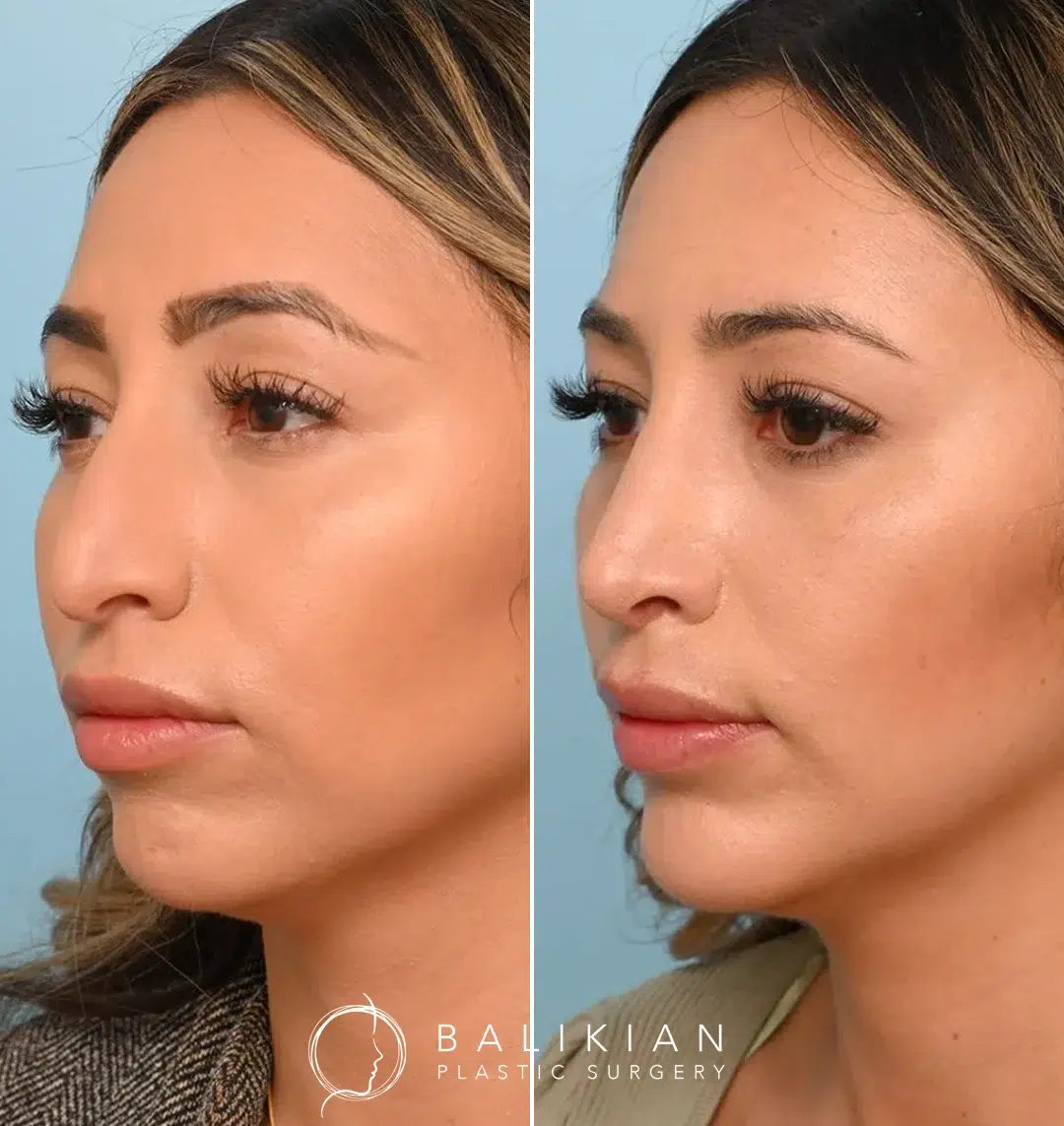 Chin augmentation before and after photo showing refined chin shape and improved lower face proportions.
