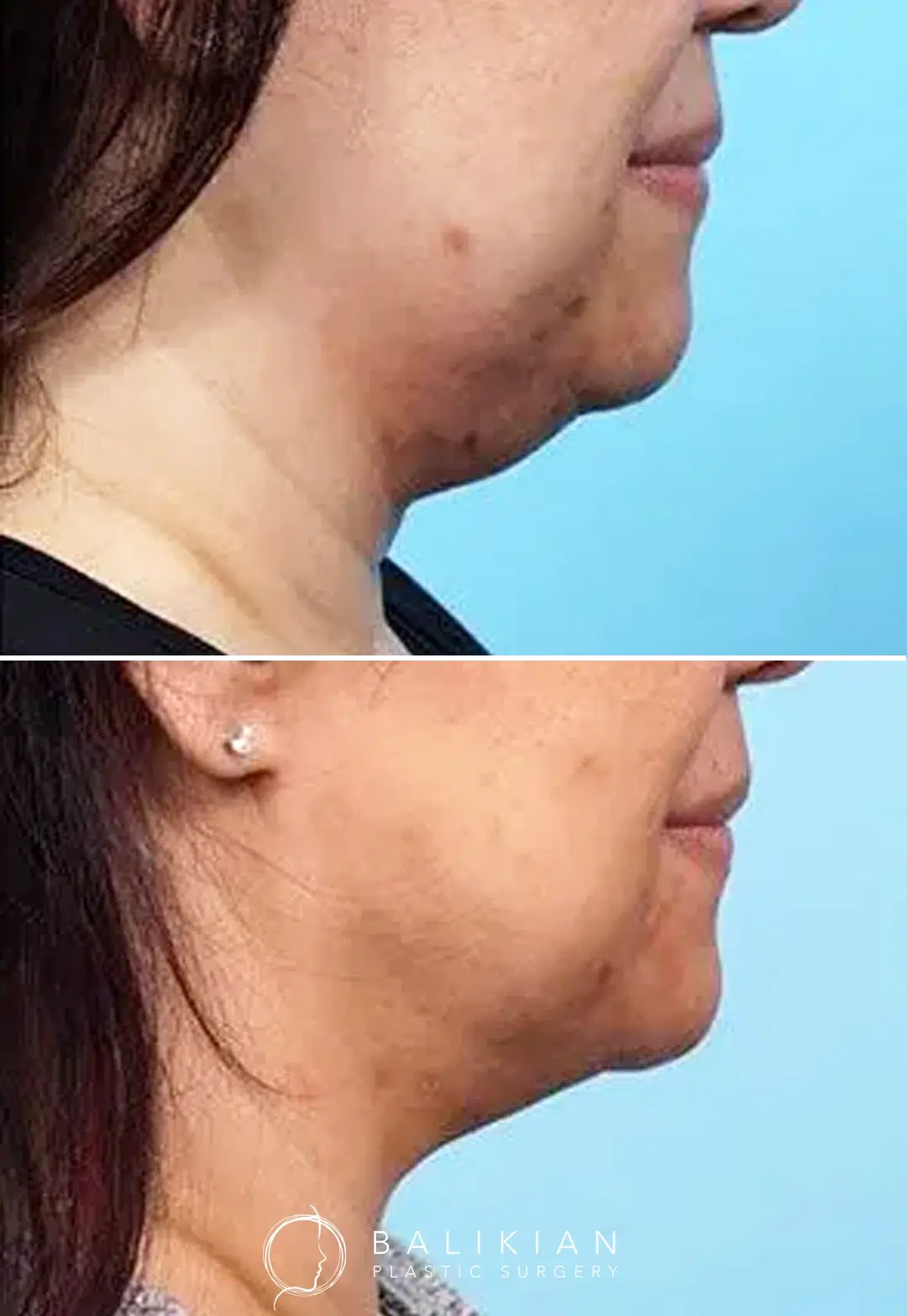 Side profile of a female patient before and after CoolSculpting under the chin. The after image shows reduced submental fullness and a more defined jawline.