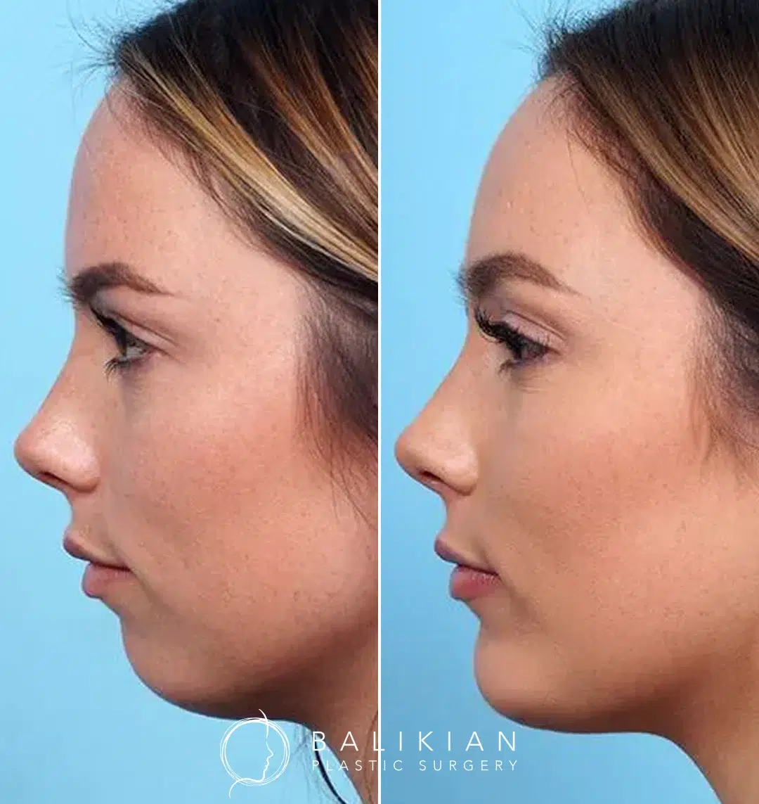 Chin enhancement before and after in Orange County, revealing a stronger profile and improved facial balance.