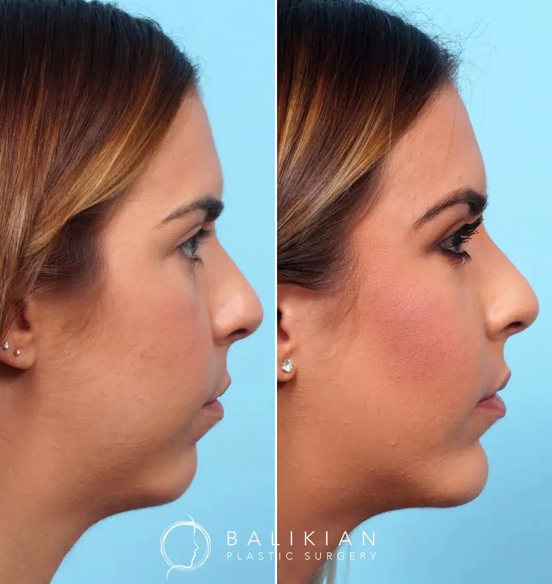 Before and after chin enhancement in Orange County, showing subtle yet impactful improvements to the jawline.
