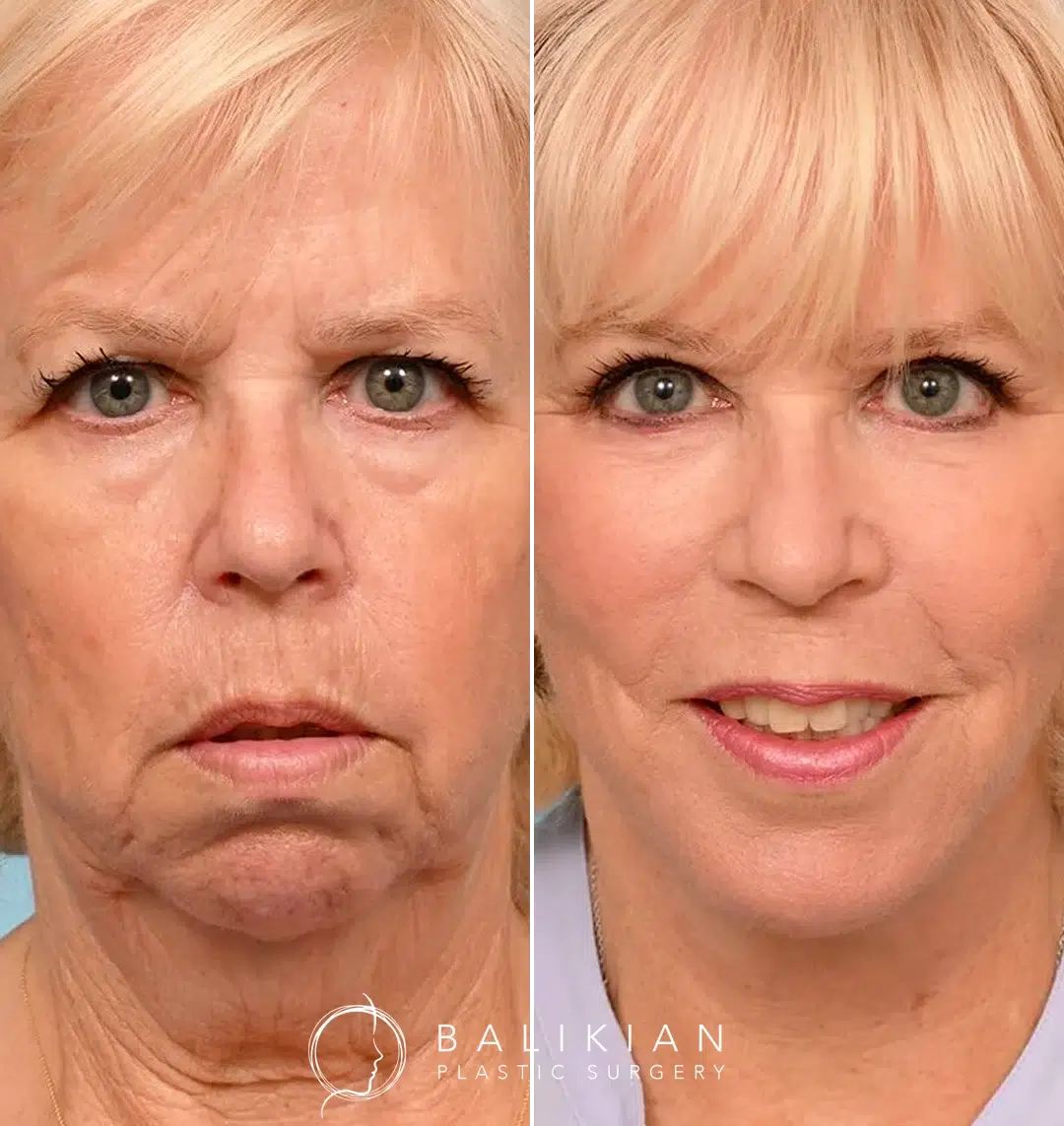 Chin implant before and after in Temecula, demonstrating enhanced chin projection and improved side profile.